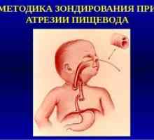 Atrezia esofagului la nou-născuți