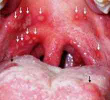 Herpesul în gât: simptome și tratament