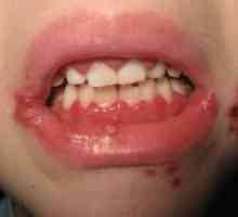 Stomatita herpetică la copii: tratament
