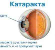 Cataracta: cauze de patologie, simptome, tratament și prevenire
