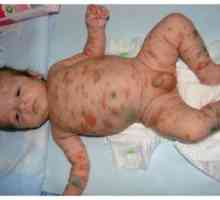 Sepsis la nou-născuți: cauze, natură și simptome
