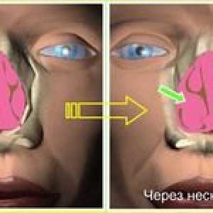 Ce este rinita hiperplazică?