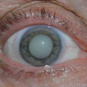 Ce este ochiul de cataractă, simptome