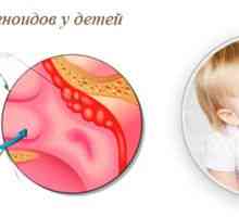 Adenoizii la copii: simptome și tratament