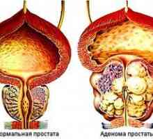 Adenomul de prostată: tratamentul cu medicamente populare