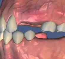 Adentia dinților: cauze, simptome, tratament la copil