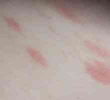 Alergii la nivelul pielii, pete roșii sunt mâncărime: tratament