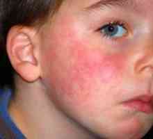 Alergia la lapte la un copil, simptome și dezvoltare