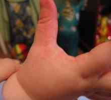 Alergii pe degetele copilului și pe mâini