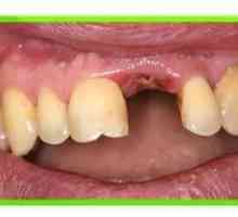 Alveolita după tratamentul și prevenirea extracției dinților