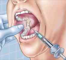 Anestezia în stomatologie: tipuri, descriere și metode