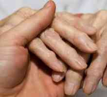 Artrita degetelor: simptomele bolii și tratamentul necesar