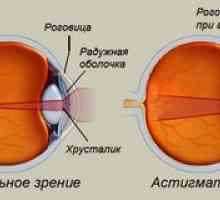 Astigmatismul ochiului: ceea ce este, fotografie, tratamentul la adulți