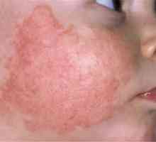 Dermatita atipică: tipurile și metodele sale de tratament