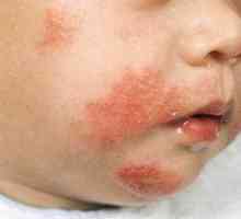 Dermatita atopică la copii: fotografii ale simptomelor și ale tratamentului