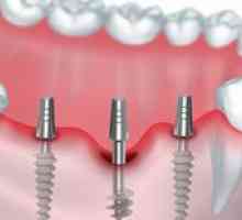 Implantarea bazală: avantajele implantării bazale a dinților