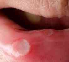Acoperire albă pe buze: cauze, simptome, tratament