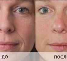 Biorevitalizarea noninjectivă a feței cu acid hialuronic