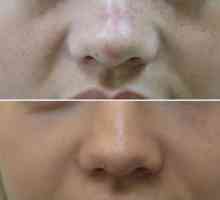 Rinoplastia non-chirurgicală a nasului cu umpluturi și fire