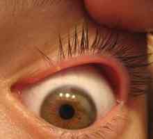 Blefarita ochiului: ceea ce este, simptome, tratament