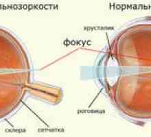 Micopie, hipermetropie. De ce razele nu se concentrează pe retină?