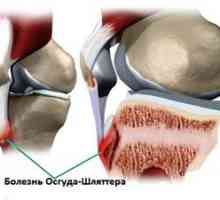 Boala ciocanului și metodele de tratare a osgudei articulației genunchiului