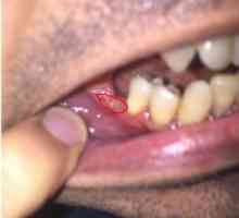 Durerea după extragerea dinților, ce trebuie să faceți
