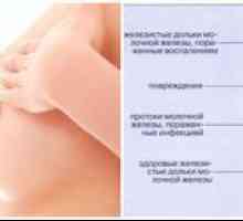 Pieptul pieptului în timpul alăptării: cauze, simptome și tratament
