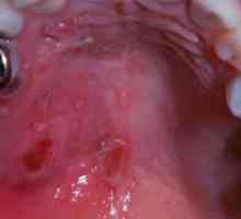 Palatul gurii este dureros: cauze și tratament