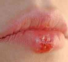 Răni pe buze: o varietate de leziuni, cauze, simptome