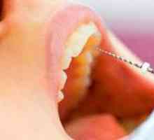 Este dureroasă îndepărtarea nervului din dinte?
