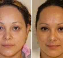 Botox pentru față: contraindicații înainte și după