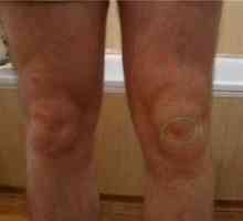 Bursita genunchiului: simptome și tratament