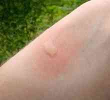 Ceea ce trebuie să faci mușcăturile de țânțari unui copil