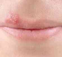 Decât herpesul pe buze în timpul sarcinii este periculos
