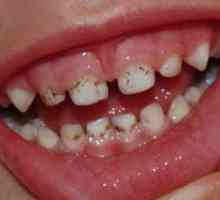 Placa neagră pe dinți: cauzele apariției și căile de eliminare