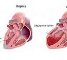 Ce este - astmul inimii, simptomele și tratamentul