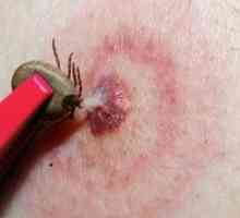Ce este boala Lyme: cauze, simptome și tratament
