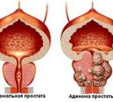 Ce este o glandă de prostată: simptome și tratament?