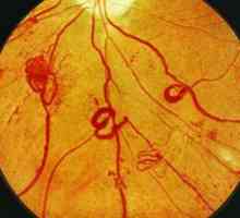 Ce este retinopatia diabetică: stadiile, simptomele și tratamentul