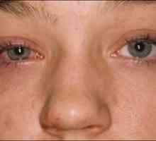 Ce este aceasta - keratita a ochiului: simptome, fotografii și tratament