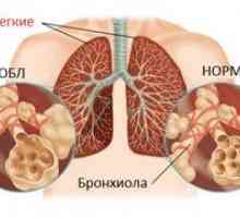 Ce este? - Obstrucția pulmonară: clasificare și tratament