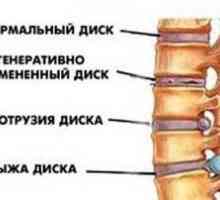Ce este - proeminența discurilor coloanei vertebrale și cum să le tratezi