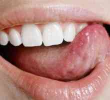 Care sunt leziunile albe din gură?