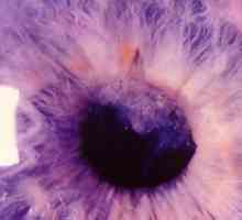 Ce este aphakia, trăsături ale acestei patologii a ochiului