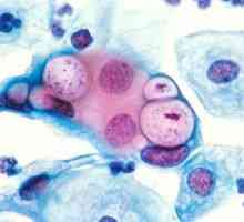 Ce este chlamydia trachomatis: simptomele și tratamentul chlamidiei
