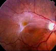 Ce este fibroza oculară epiretinală?