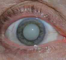 Ce este ochiul de cataractă, simptome