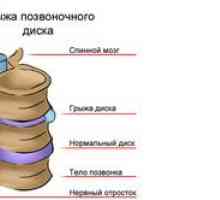Care este hernia intervertebrală a regiunii toracice, simptomele și tratamentul acesteia