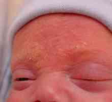 Ce este dermatita seboreică la copii?